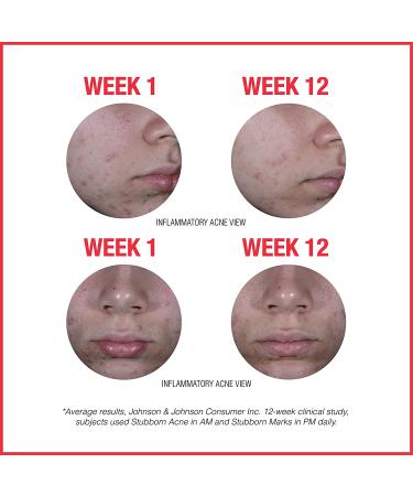 Neutrogena Stubborn Marks PM Treatment - 1 fl oz (29 ml) for Clearer Skin - Buy Online on GoSupps.com