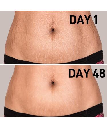 AOAO Stretch Mark Oil for Pregnancy and Body Oil for Pregnant Women Morocco Nut Oil Help for Scars and Stretch Marks Removal and Prevention Repair Firming & Smoothing Fine Lines - 100ml/1pack 1_Pack/100ml - Buy Online on GoSupps.com