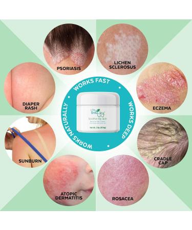 Soothe My Skin Cream - Natural Eczema, Psoriasis & Dermatitis Relief with Emu Oil - Buy Online on GoSupps.com
