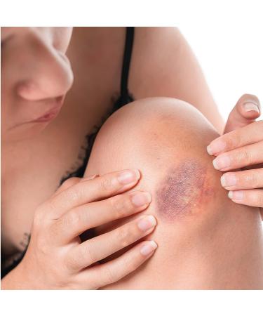 LuxeJoie Bruise & Scar Cream 4 oz - Arnica, MSM, Shea Butter, Vitamin A, E & C - Natural USA Made Treatment for Hydration & Moisturization - Buy Online on GoSupps.com