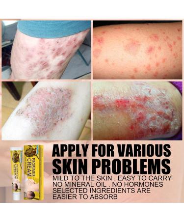 Inalsion Revitaskin Eczema Cure Cream - Eczema & Psoriasis Treatment Relief for Adults (3pcs) - Buy Online on GoSupps.com