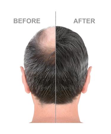Advanced 5% Minoxidil Hair Regrowth Treatment for Men - 6 Month Supply for Thinning Hair & Hair Loss - Topical Solution for Fuller Thicker Hair - Buy Online on GoSupps.com