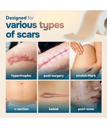 Reusable Silicone Scar Tape Sheets (120 x 1.6 ) - Medical Grade Treatment for Surgical Scars Keloids & Burns - Customizable for Tummy Tucks & C-Sections - Buy Online on GoSupps.com