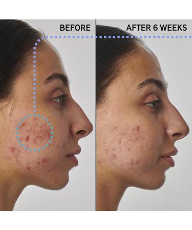 INKEY List SuperSolutions 1% Retinol Serum for Face & Neck - Reduces Scars Wrinkles & Improves Skin Tone | Healthy-Looking Skin - 1.01 fl oz - Buy Online on GoSupps.com