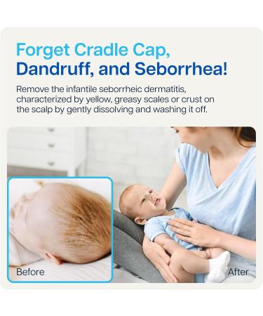 NAVEH PHARMA Cradle Cap Cleanser For Baby & Kids | 100% Natural Cradle Cap Treatment | Spray and Wash No Scrubbing | Better Than Shampoo Or Brush | Help With Dandruff | Olive Oil & Squalene | 30 ML - Buy Online on GoSupps.com