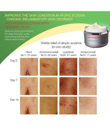 Redness Relief Face Eczema Cream - All-Natural Anti-Itch Treatment for Rosacea & Eczema - Hormone-Free Moisturizer for Facial & Body Care - Buy Online on GoSupps.com