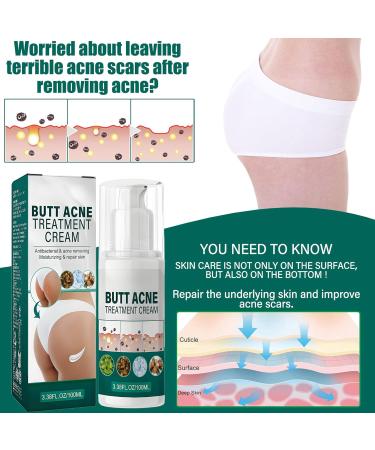Cr me nettoyante contre l'acn pour les fesses et les cuisses 100 ml de cr me d'acn pour les fesses cr me nettoyante anti-acn cr me anti-boutons sur les fesses limine les boutons et les taches - Buy Online on GoSupps.com