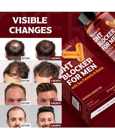 DHT Blocker for Men | Hair Growth Vitamins Supplement with Saw Palmetto & Biotin - Hair Regrowth - Natural Hair Loss Supplements Liquid-Filled - Proprietary Herbal Blends (180 Capsules) 90 Count (Pack of 2) - Buy Online on GoSupps.com