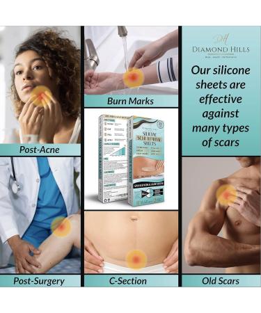 Diamond Hills Silicone Scar Removal Sheets - 4 Strips 5.9x1.57 - Fade, Flatten & Lighten Surgical Scars - Buy Online on GoSupps.com