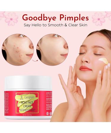 Acne Face Cream with Salicylic Acid | Cystic Acne Treatment for Face & Body | Anti-Acne Skincare for Teens & Adults | 3.53 OZ - Buy Online on GoSupps.com