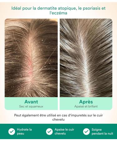 Scalp Oil - 30 ml - S rum pour cuir chevelu sec et irrit ingredients naturels et extrait de neem 30ml - Buy Online on GoSupps.com