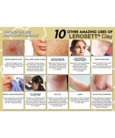 LEROSETT Spot Treatment & Clay Mask - Swedish Clay for Acne Prone Skin - Minimize Pores, Pimples, Blackheads, Detox & Blemishes - All-Natural, Vegan - 3 oz - Buy Online on GoSupps.com