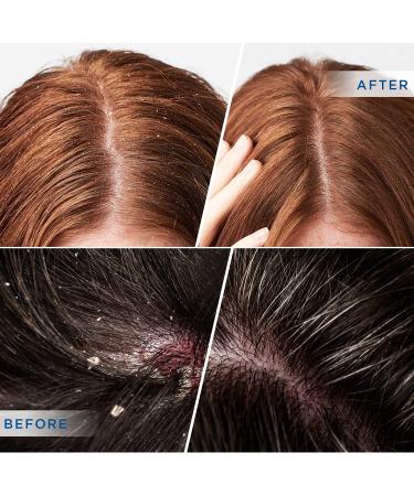 DERPHEA Psoriasis Folliculitis Seborrheic Dermatitis Dry Itchy Scalp Shampoo - Safe for All Skin Types | Blue - Buy Online on GoSupps.com