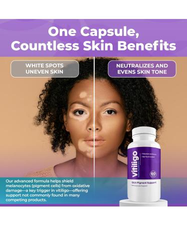 AURA VITAMINS - Vitiligo Capsules 60 Count | 1 Month | Improve Skin Pigmentation Support and Reduce White Spots | Effective Vitiligo Supplement | Natural Solution for White Spots on Skin. (1) - Buy Online on GoSupps.com