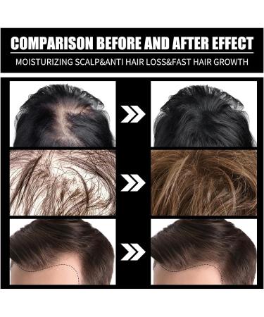 S rum de Croissance de Cheveux Serum Pousse Cheveux Serum Cheveux Pousse Rapide Liquide de Croissance des Cheveux Anti Chute Cheveux Traitements Pour la Repousse des Cheveux - Buy Online on GoSupps.com