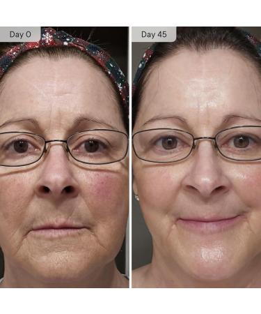 Qure Micro-Infusion System for Face - All Skin Types Easy 5min at-Home Skincare Facial Application - 3 Month Supply 3 Month - 6 Sessions - Buy Online on GoSupps.com