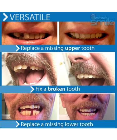 Instant Smile Temporary Tooth Kit - Pro-Series: Transform Your Smile Instantly - Buy Online on GoSupps.com