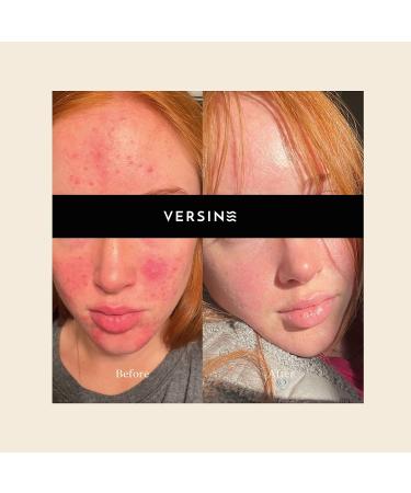 Versine Gentle Actives Serum for Acne Prone Skin | Pregnancy Safe with Azelaic Acid & Vitamins | Anti-Aging & Brightening Moisturizer | 1 Fl Oz - Buy Online on GoSupps.com