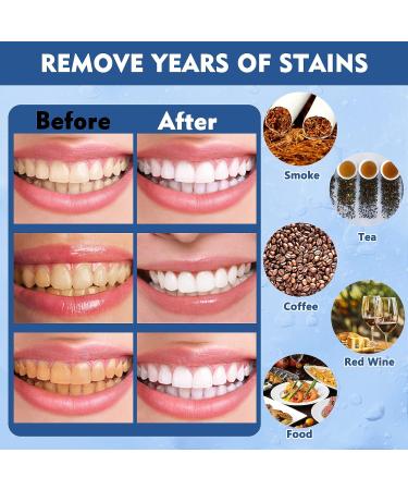 Teeth Whitening Pen Set - Fast & Effective Tooth Whitening Gel for Bright White Teeth, Removes Years of Stains, No Sensitivity - Oral Care Solution - Buy Online on GoSupps.com