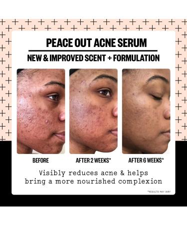Peace Out Skincare Acne Serum - 2% Salicylic Acid for Clear Skin | Daily Multi-Benefit Face Serum | International Shipping Available - Buy Online on GoSupps.com