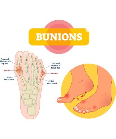 Pedag Bunion Protector & Forefoot Pad - Made in Germany | Cushions & Protects Bunions | Eases Pain | Reusable & Washable | Large/X-Large - Buy Online on GoSupps.com