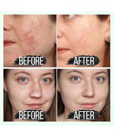 Blackhead Remover for Face & Nose - Deep Cleansing Pore Treatment for All Skin Types | Acne Solution for Men & Women - Buy Online on GoSupps.com
