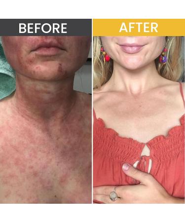 Satya Organic Eczema Balm - Easy Glide Eczema Chafe Stick - Full Body Chafing Balm - Eczema Cream Baby and Adults - 1 oz Eczema Treatment Eczema Glide Stick - Buy Online on GoSupps.com