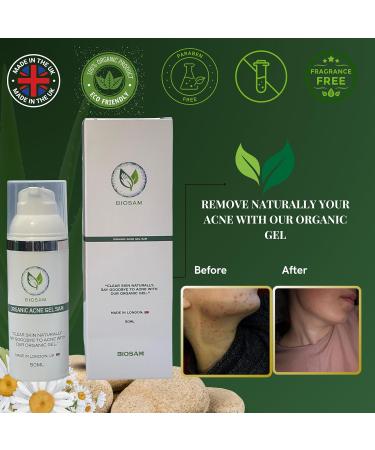 BioSam Acne Gel Pro: Acne-Fighting Moisturizer - Organic Blemish & Scar Treatment Gel with AHA Fruit Acids Vitamin C and Chamomile Ideal for Acne-Prone Skin Prevents Blackheads & Whiteheads - Buy Online on GoSupps.com