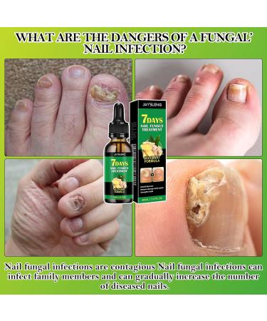 Huile de soin des ongles au gingembre pour la r paration des ongles - Pour ongles cassants - Buy Online on GoSupps.com