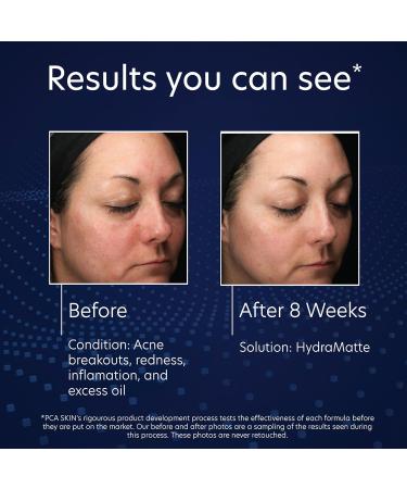 PCA SKIN HydraMatte Oil Control Moisturizer Face Moisturizer for Oily Skin Helps Reduce Oil and Promotes a Smoother Complexion Absorbs Quickly Great for Combination and Oily Skin 1.8 oz Jar - Buy Online on GoSupps.com