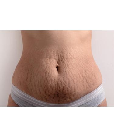 Ultimate Stretch Mark Repair Product with 20% Collagen 20% Retinol 20% Hyaluronic Acid & 20% Elastin - Buy Online on GoSupps.com