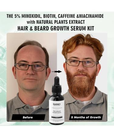 5% Minoxidil Hair & Beard Growth Serum - Biotin & Caffeine - Natural Extracts for Thicker Fuller Hair & Beard - Unisex Solution - International Shipping Available - Buy Online on GoSupps.com