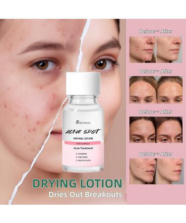 SIRUIMAO Premium Drying Lotion with Swab Overnight Solution For Face and Body Dry Out Pimples Blemishes Zits And Clean Pores 12ml / 0.41 FlOz - Buy Online on GoSupps.com