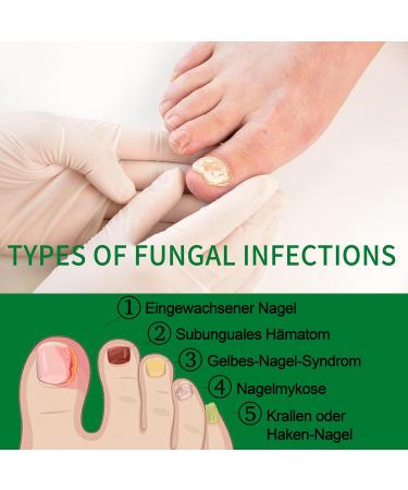 Ginger Nail Care Oil - Huile de soin des cuticules - S rum pour ongles cassants d color s et cass s - Huile de soin des ongles Ginger Cuticle Care pour ongles - Huile de soin des ongles - Soin des - Buy Online on GoSupps.com