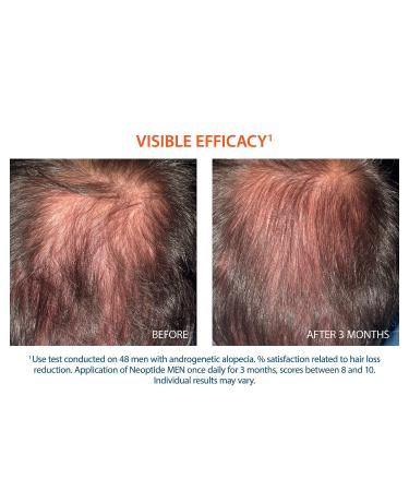 Ducray Neoptide Men Hair Lotion - 0.32 lb | Promotes Hair Growth & Thickness - Buy Online on GoSupps.com