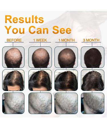 Minoxidil Hair Growth Serum - Biotin Treatment for Stronger, Thicker Hair - Prevent Hair Loss & Regrow Naturally - 1Fl Oz - Buy Online on GoSupps.com