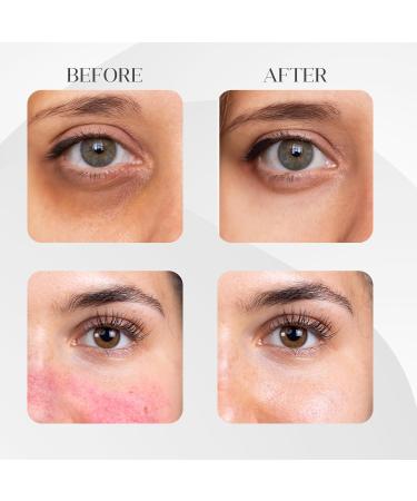 FEEL MATRIGEN Vitamin K 100 Ampoule Redness & Dark Circle Treatment Serum for Sensitive Skin 30mL + Needleless Syringe - Buy Online on GoSupps.com