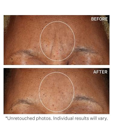 StriVectin Anti-Wrinkle SD Advanced Plus - Intensive Moisturizing Concentrate for Wrinkles & Stretch Marks, 2 Fl Oz - Buy Online on GoSupps.com