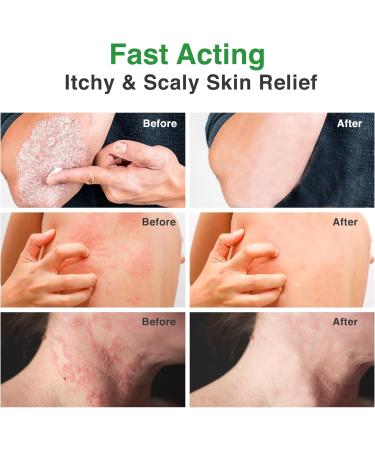 PLENO Ringworm Treatment - Antifungal Spray & Cream for Jock Itch Eczema Tinea Versicolor Athletes Foot | Fast Relief for Rash & Itchy Skin - Buy Online on GoSupps.com