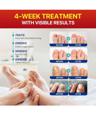 Nail Fungus Treatment For Toenails: Nail Fungus Patches For Altheles Runners Dancers Hikers 32 Patches - Buy Online on GoSupps.com