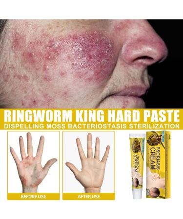 Inalsion Revitaskin Eczema Cure Cream - Eczema & Psoriasis Treatment Relief for Adults (3pcs) - Buy Online on GoSupps.com