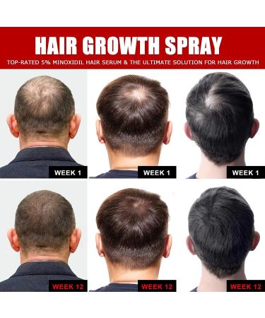 Ceessting Hair Growth Spray - Biotin, Caffeine & Niacinamide - 2oz Anti-Hair Loss & Regrowth Treatment for Men & Women - Buy Online on GoSupps.com