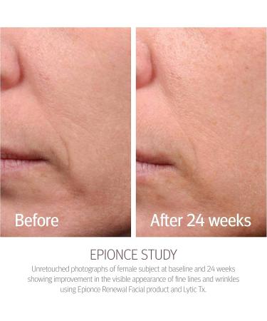 Epionce Renewal Lite Facial Lotion oily skin 1.7 Fl Oz - Buy Online on GoSupps.com