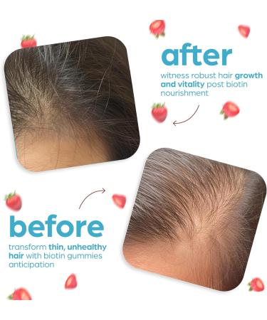 Artnaturals Biotin Gummies for Hair Growth - (100 Gummies - 10000mcg) - Natural Strawberry Vitamins Supports Nails and Skin - Gelatin, Gluten, Nut and Egg Free - Buy Online on GoSupps.com