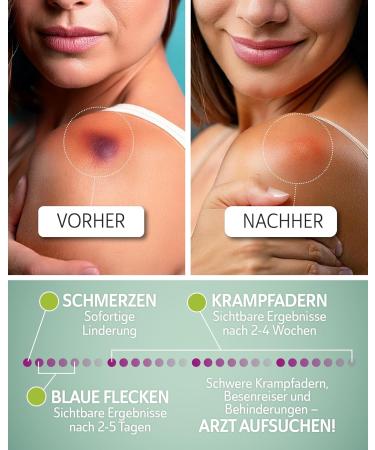  Vipis VIPIS Horse Chestnut Ointment Gel - Vein Ointment & Varicose Vein Cream with Purple & Menthol - Fast Absorbing & Cooling Cream for Spider Veins Tired & Heavy Legs Swollen Feet & Muscles - Buy Online on GoSupps.com