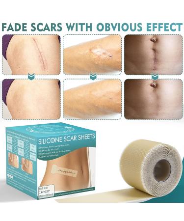 Professional Silicone Scar Sheets Roll 1.6x120 - Effective for C-Section, Surgery, Burns, Keloids - 3M Silicone Tape for Old & New Scars - Buy Online on GoSupps.com