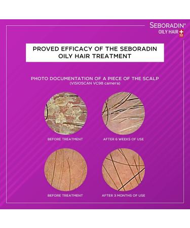 Seboradin Ampoules for Greasy Hair Hair Loss Dandruff & Psoriasis Treatment Scalp Care Serum for Men & Women (14x5.5ml) - Buy Online on GoSupps.com