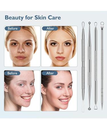Blackhead Remover Tool FeiMar Pimple Extractor Kit 9 Pcs Profassional Comedone Extractor Tool with Face Razor Women Suitable as Pimple Acne Blemish Whitehead Remover - Buy Online on GoSupps.com