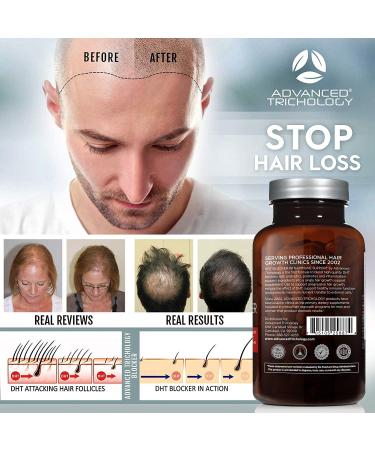 DHT Blocker Hair Growth Supplement for Genetic Thinning | Approved by American Hair Loss Association | 20 Years of Experience in Hair Loss Treatment Clinics - Buy Online on GoSupps.com