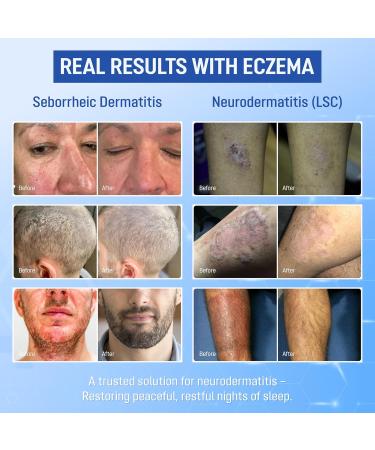 ABERA Seborrheic Dermatitis Cream Relief for Psoriasis & Eczema with Peptizinc + Herbal Complex Neurodermatitis Comfort Soothes Itching Face Scalp & Body Daily Relief Steroid Free (1.01 Fl Oz) 1 Box - Buy Online on GoSupps.com